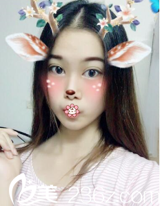 李祐誠韓式雙眼皮術(shù)后19天 李祐誠韓式雙眼皮術(shù)后19天