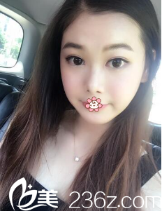 韓國ROSE整形外科雙眼皮術(shù)后一個月 韓國ROSE整形外科雙眼皮術(shù)后一個月