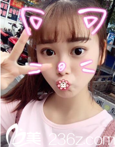 韓國ROSE整形外科李祐誠做的這開扇型韓式雙眼皮開內(nèi)眼角是我想象中的樣子！