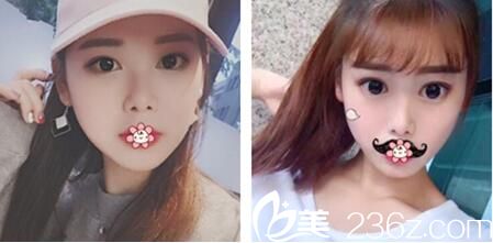 韓國ROSE整形外科李祐誠雙眼皮術(shù)后三個月 韓國ROSE整形外科李祐誠雙眼皮術(shù)后三個月