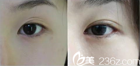 廉沅錫院長三眼皮修復(fù)案例 廉沅錫院長三眼皮修復(fù)案例