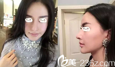 許琎院長(zhǎng)歪鼻修復(fù)案例 許琎院長(zhǎng)歪鼻修復(fù)案例