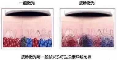 皮秒激光與一般激光能量的對(duì)比 皮秒激光與一般激光能量的對(duì)比