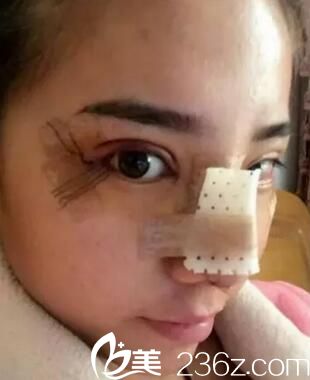 <!--<i data=20240703-sp></i>-->做眼鼻整形手術(shù) <!--<i data=20240703-sp></i>-->做眼鼻整形手術(shù)