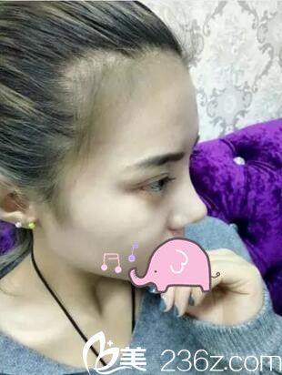 <!--<i data=20240703-sp></i>-->雙眼皮開眼角隆鼻案例 <!--<i data=20240703-sp></i>-->雙眼皮開眼角隆鼻案例