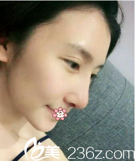 許琎隆鼻失敗修復(fù)術(shù)后一周