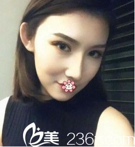 韓國GAAM整形外科隆鼻失敗修復(fù)術(shù)后20天