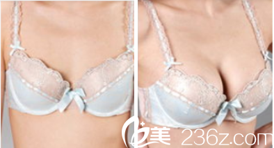 北京豐聯(lián)麗格王冀耕假體隆胸案例