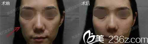 高益秀院長面部年輕化手術(shù)案例對比效果 高益秀院長面部年輕化手術(shù)案例對比效果