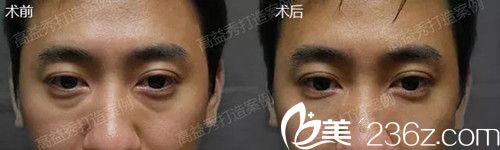 高益秀院長祛眼袋手術(shù)案例 高益秀院長祛眼袋手術(shù)案例