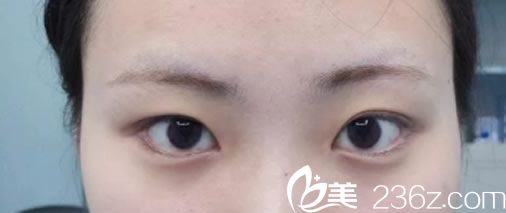 來福琳整形手術(shù)前