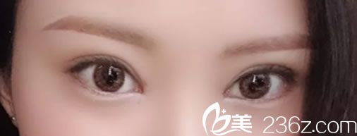 李榮鐘全切雙眼皮一個后恢復(fù)效果案例