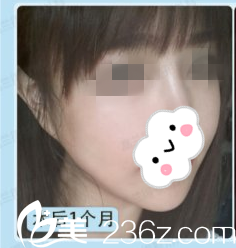 術(shù)后一個(gè)月 術(shù)后一個(gè)月