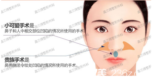 貴族手術和小可愛手術的手術部位