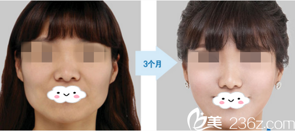 韓國高蘭得貴族手術前后對比