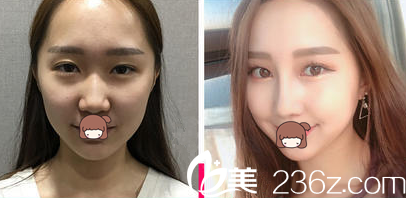 張宅鎮(zhèn)眼鼻整形案例