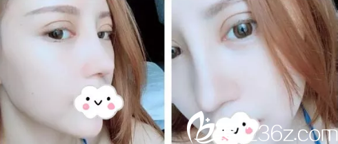 術(shù)后一周雙眼皮和鼻子腫脹減輕