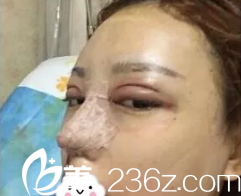 剛做完雙眼皮和隆鼻手術(shù)都比較腫脹