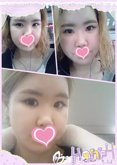 金光鎮(zhèn)院長面部輪廓手術(shù)案例 金光鎮(zhèn)院長面部輪廓手術(shù)案例