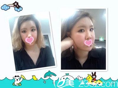 眼型矯正后8天 眼型矯正后8天