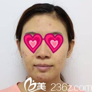 在延世明星皮膚科做祛痘術前照 在延世明星皮膚科做祛痘術前照