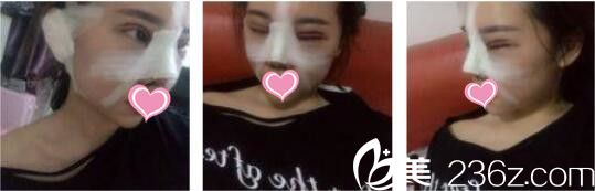 韓國UNIMEDI整形外科尹仁模韓式雙眼皮+假體隆鼻真人案例術后第二天