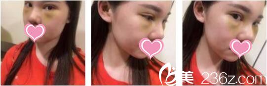 韓國UNIMEDI整形外科尹仁模韓式雙眼皮+假體隆鼻真人案例術后第七天