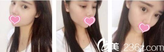 韓國UNIMEDI整形外科尹仁模韓式雙眼皮+假體隆鼻真人案例術后一個月