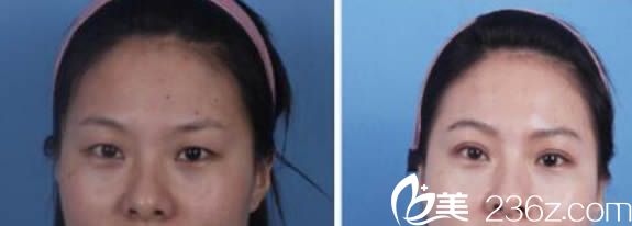廣州紫馨整形雙眼皮案例圖 廣州紫馨整形雙眼皮案例圖