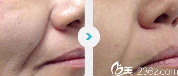 趙珠延院長面部提升前后對比圖 趙珠延院長面部提升前后對比圖