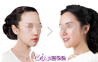 全胤株院長(zhǎng)MISKO隆鼻整形案例 全胤株院長(zhǎng)MISKO隆鼻整形案例