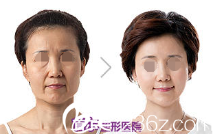 臉部脂肪移植術(shù)案例 臉部脂肪移植術(shù)案例