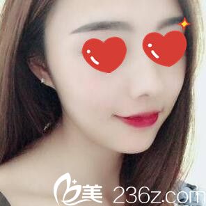 快看長(zhǎng)沙臉博士整形醫(yī)院唐永豐給我做的鼻綜合術(shù)后一個(gè)月效果超自然，我很滿意！