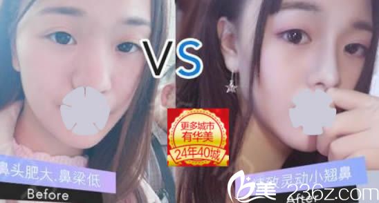 廈門華美整形隆鼻效果對比圖