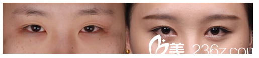開(kāi)眼角手術(shù)案例對(duì)比圖 開(kāi)眼角手術(shù)案例對(duì)比圖