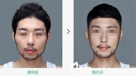 韓國原辰整形外科顴骨整形真人前后對(duì)比