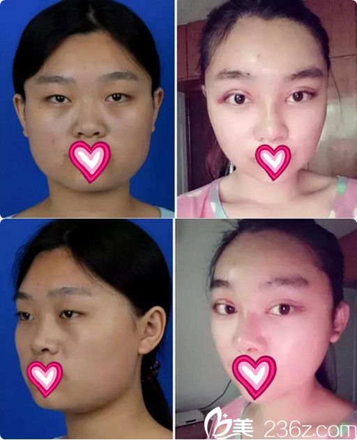 看到朋友在連云港美締做的隆鼻效果驚艷 也去面診做了下頜角整形+雙眼皮