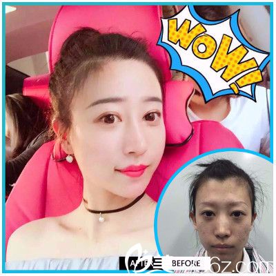 惠州元辰醫(yī)療美容醫(yī)院葉明龍做的雙眼皮隆鼻案例