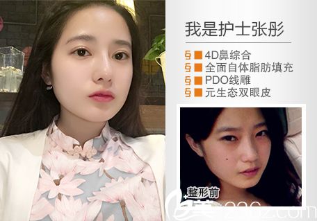 惠州時(shí)光整形醫(yī)院葉明龍做的雙眼皮隆鼻效果 惠州時(shí)光整形醫(yī)院葉明龍做的雙眼皮隆鼻效果
