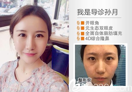惠州元辰整形醫(yī)院葉明龍雙眼皮隆鼻案例