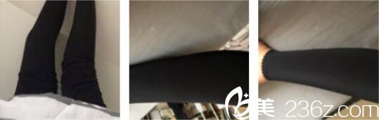 韓國Valinew抽脂好不好？看申怡暻為我做的抽脂瘦小腿術(shù)后三個月效果圖