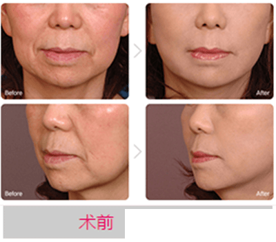魯峰<!--<i data=20240703-sp></i>-->長面部除皺手術(shù)案例 魯峰<!--<i data=20240703-sp></i>-->長面部除皺手術(shù)案例