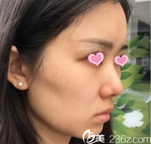 在北京葉子做面部脂肪填充前樣子 在北京葉子做面部脂肪填充前樣子