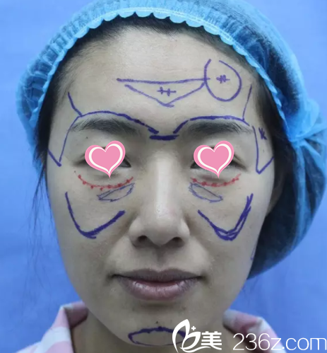 魯禮新給我做面部脂肪填充設(shè)計(jì)照 魯禮新給我做面部脂肪填充設(shè)計(jì)照