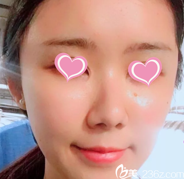 北京葉子面部脂肪填充案例 北京葉子面部脂肪填充案例