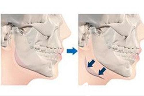 下頜角手術 下頜角手術