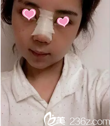 找北京葉子李明自體軟骨隆鼻3天樣子 找北京葉子李明自體軟骨隆鼻3天樣子