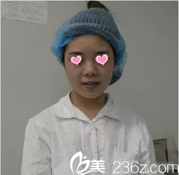 在北京葉子做隆鼻前樣子 在北京葉子做隆鼻前樣子