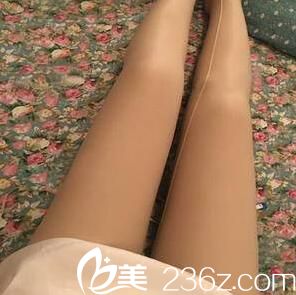 吸脂瘦腿術(shù)后第九天效果 吸脂瘦腿術(shù)后第九天效果