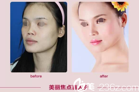 南寧美麗焦點(diǎn)假體隆鼻案例